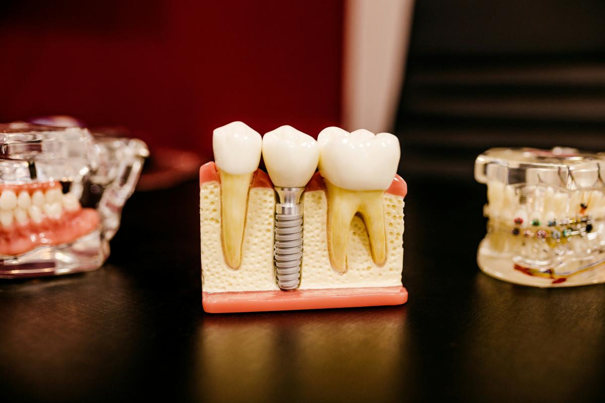 Dental implant model highlighting dental treatments covered under CHAS card subsidies