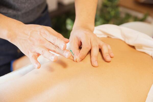 Therapist treating a patient with needles during an alternative medicine procedure